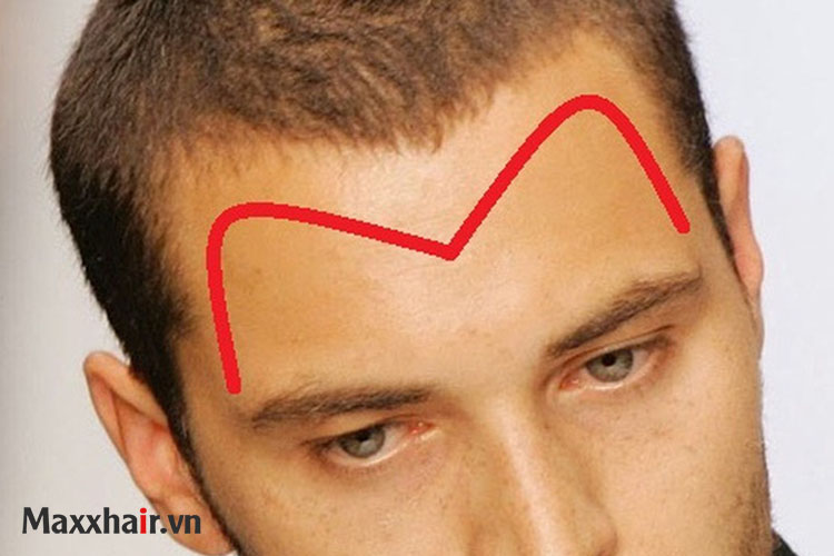 Các kiểu rụng tóc nhiều ở nam thường gặp 1 Các kiểu rụng tóc nhiều ở nam thường gặp 1
