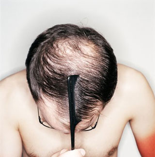 Hói đầu - nỗi niềm muôn thủa 1 Hói đầu - nỗi niềm muôn thủa 1