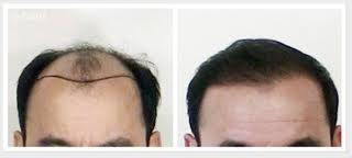 a. Cấy tóc 1 a. Cấy tóc 1