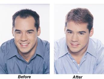 c. Cấy T óc nhân tạo 2 c. Cấy T óc nhân tạo 2