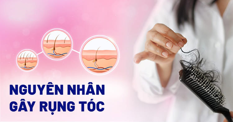 Các nguyên nhân gây ra tình trạng rụng tóc sau sinh Các nguyên nhân gây ra tình trạng rụng tóc sau sinh