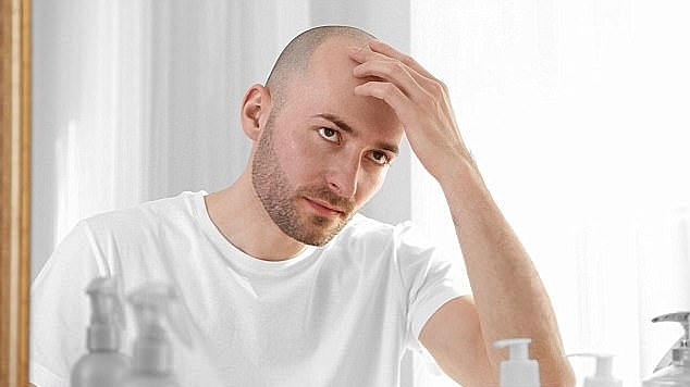 Top 7 cách trị hói đầu bằng thiên nhiên có ngay trong nhà bạn 1 Top 7 cách trị hói đầu bằng thiên nhiên có ngay trong nhà bạn 1