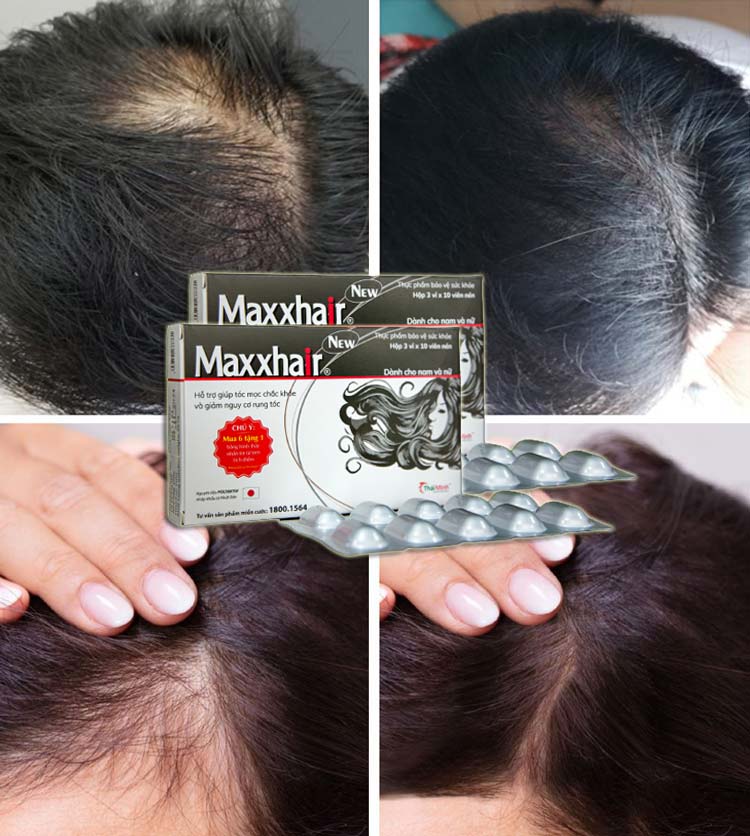 Hình ảnh trước và sau khi sử dụng Maxxhair 2 - 3 tháng của nhiều khách hàng Hình ảnh trước và sau khi sử dụng Maxxhair 2 - 3 tháng của nhiều khách hàng
