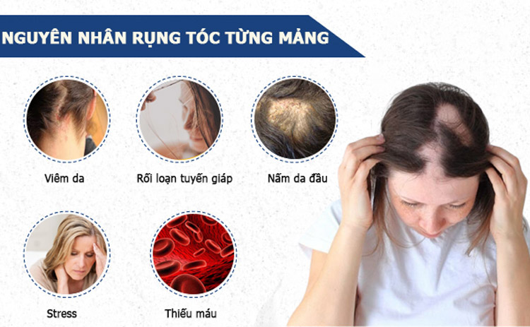 Nguyên nhân chính gây ra tình trạng rụng tóc thành từng mảng Nguyên nhân chính gây ra tình trạng rụng tóc thành từng mảng