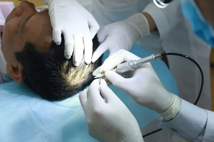 Cấy tóc Cấy tóc