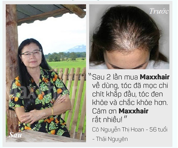 6 Lý do nên chọn Maxxhair để điều trị rụng tóc nhiều, hói đầu 6 6 Lý do nên chọn Maxxhair để điều trị rụng tóc nhiều, hói đầu 6