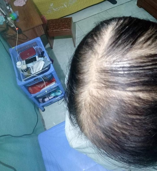 Tóc rụng cả mảng trơ trụi trên đầu 1 Tóc rụng cả mảng trơ trụi trên đầu 1