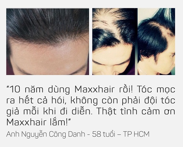 Tại sao nên chọn Maxxhair khi bị Rụng tóc nhiều, Hói đầu sớm? 5 Tại sao nên chọn Maxxhair khi bị Rụng tóc nhiều, Hói đầu sớm? 5