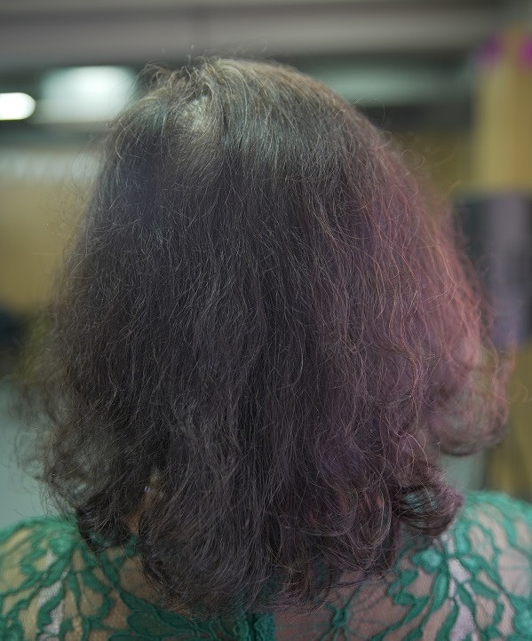 Tuổi cao không tránh khỏi tóc rụng nhiều 1 Tuổi cao không tránh khỏi tóc rụng nhiều 1