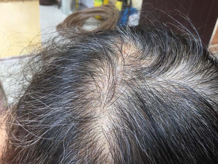 Chưa già mà tóc đã rụng nhiều lại còn bạc trắng 2 Chưa già mà tóc đã rụng nhiều lại còn bạc trắng 2