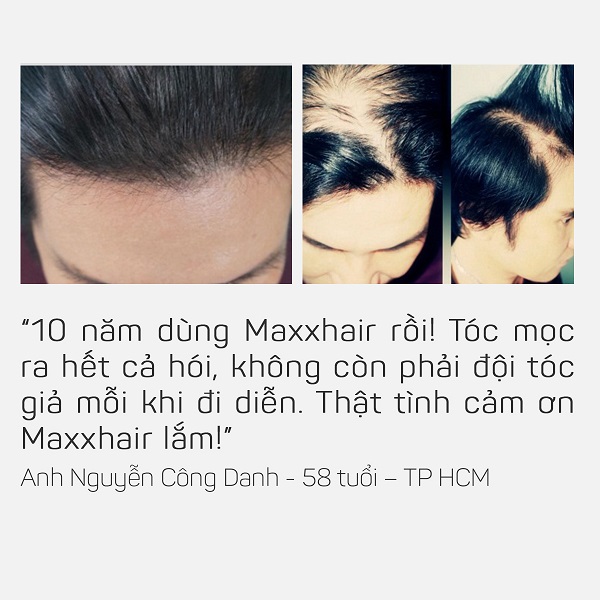 Ai đã sử dụng Maxxhair? 2 Ai đã sử dụng Maxxhair? 2