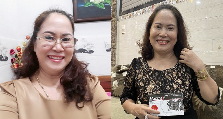 Dù hói bóng cả da đầu cũng có cách giúp tóc mọc trở lại