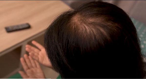 Tóc rụng nhiều như trút, làm sao để mọc nhanh lại được?