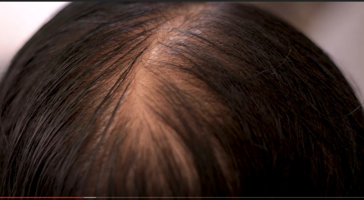 Tóc rụng chỉ còn phân nửa sau một thời gian ngắn 1 Tóc rụng chỉ còn phân nửa sau một thời gian ngắn 1