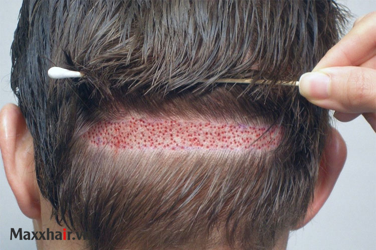 2. Cấy tóc 1 2. Cấy tóc 1