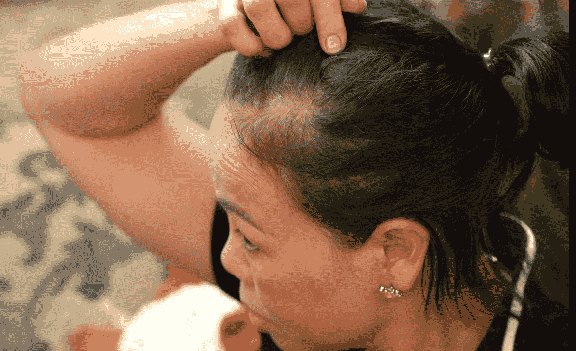 Hốt hoảng vì tóc rụng nhiều đến phân nửa 1 Hốt hoảng vì tóc rụng nhiều đến phân nửa 1