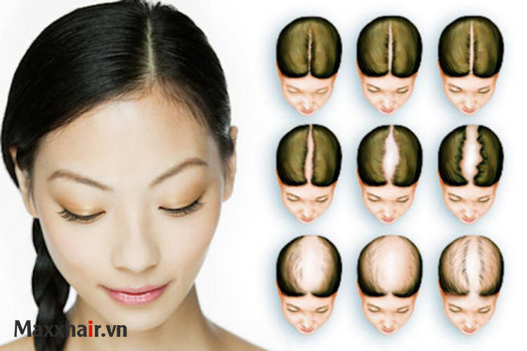 Triệu chứng hói đầu di truyền ở nữ giới 1 Triệu chứng hói đầu di truyền ở nữ giới 1