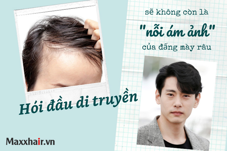 Hói đầu di truyền có chữa khỏi dứt điểm được không?