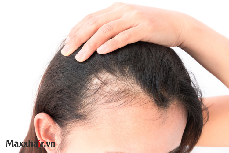 Hội chứng buồng trứng đa nang (PCOS) 1 Hội chứng buồng trứng đa nang (PCOS) 1