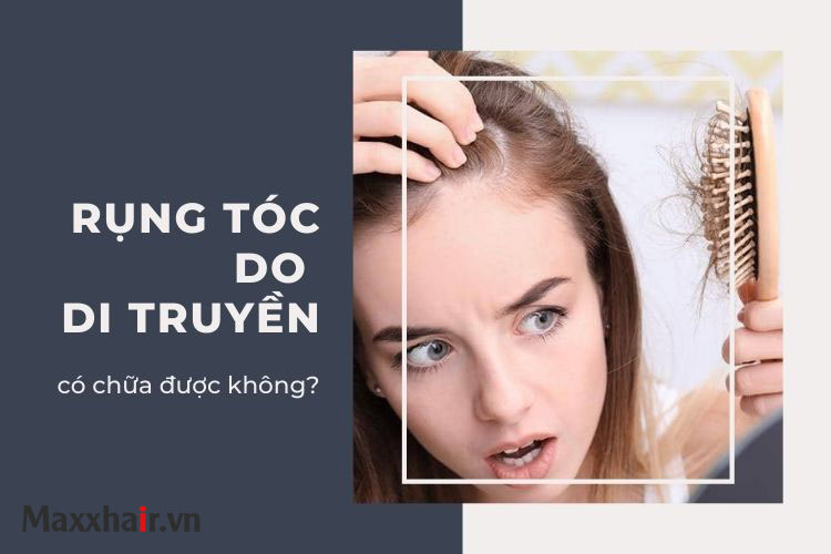 Rụng tóc di truyền có chữa được không? 1 Rụng tóc di truyền có chữa được không? 1