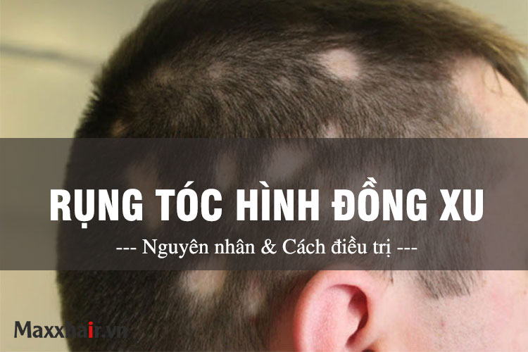 Rụng tóc hình đồng xu - Nguyên nhân và cách điều trị 1 Rụng tóc hình đồng xu - Nguyên nhân và cách điều trị 1