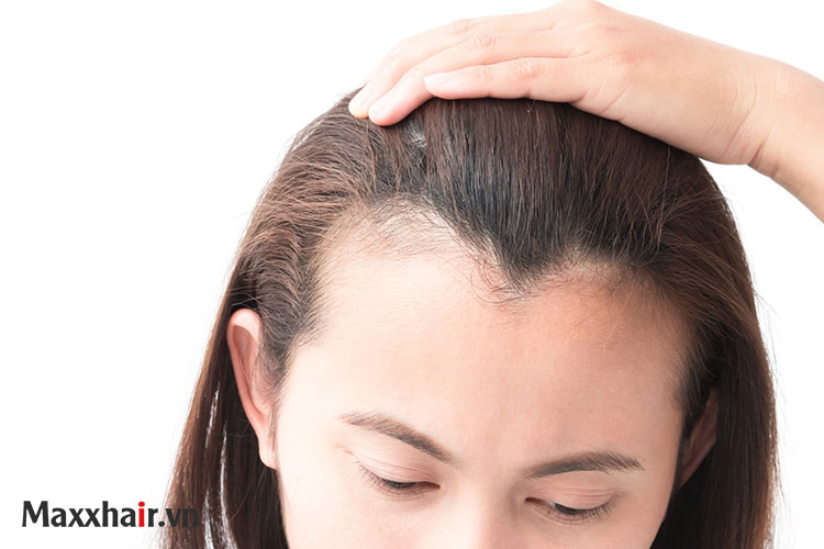 Dấu hiệu nhận biết rụng tóc ở trán 1 Dấu hiệu nhận biết rụng tóc ở trán 1