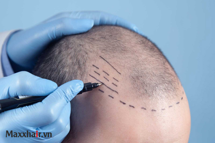 Cấy ghép nang tóc 1 Cấy ghép nang tóc 1