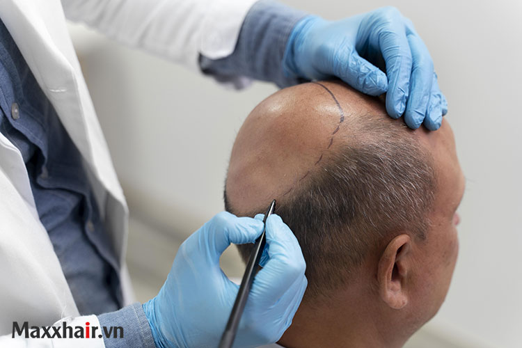 Rụng tóc do trứng cá sẹo lồi 1 Rụng tóc do trứng cá sẹo lồi 1