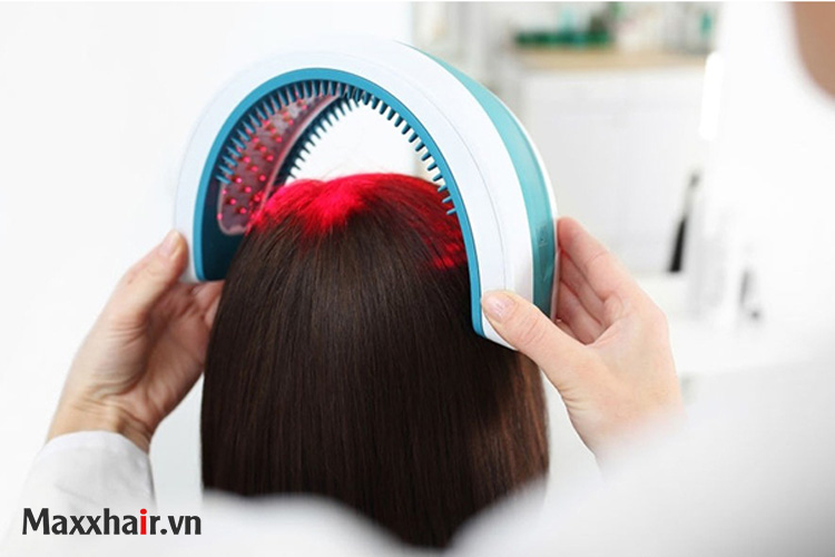 2. Laser trị rụng tóc 1 2. Laser trị rụng tóc 1