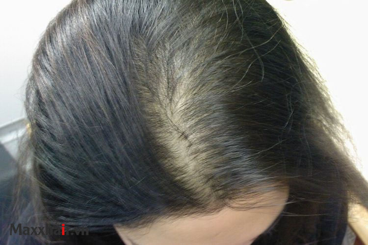 Rụng tóc androgen là gì? 1 Rụng tóc androgen là gì? 1