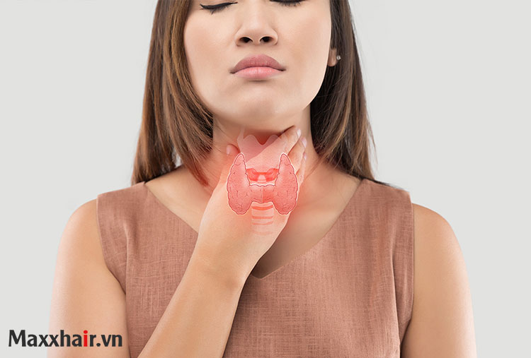 Suy giáp 1 Suy giáp 1