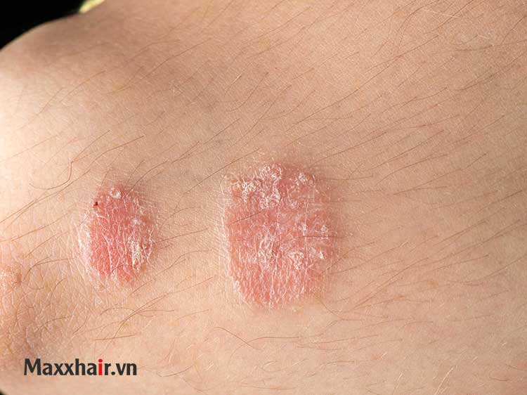 Bệnh vảy nến 1 Bệnh vảy nến 1