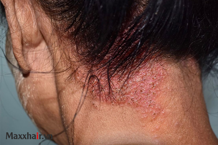 Viêm da đầu 1 Viêm da đầu 1