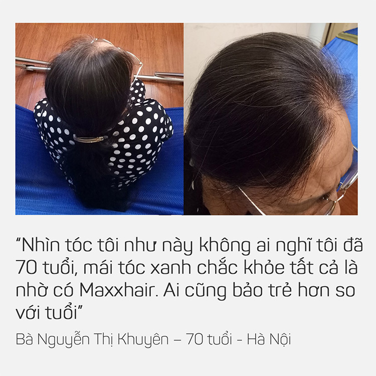 Có ai đã dùng Maxxhair hiệu quả chưa? 3 Có ai đã dùng Maxxhair hiệu quả chưa? 3