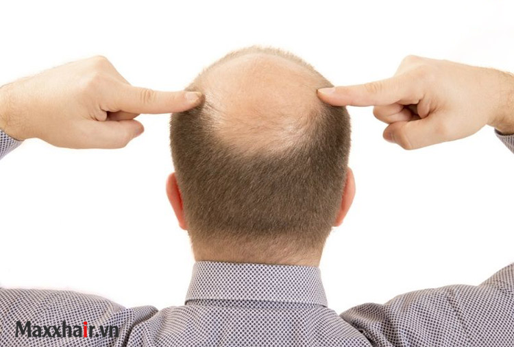 Hói đầu do nguyên nhân nào? 1 Hói đầu do nguyên nhân nào? 1