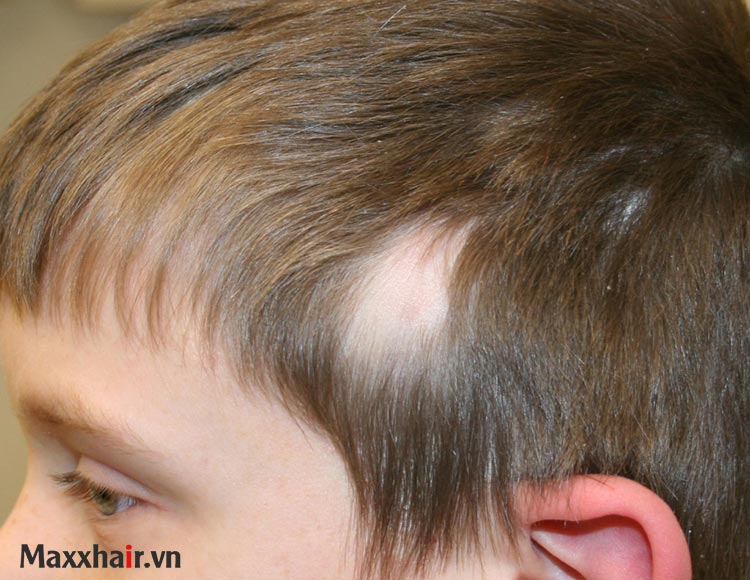 Bệnh lupus 1 Bệnh lupus 1