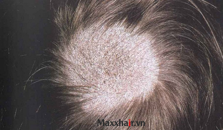 Rụng tóc do nấm da đầu 1 Rụng tóc do nấm da đầu 1