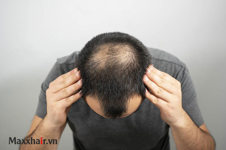 Rụng tóc con nhiều có nguy hiểm không? 1 Rụng tóc con nhiều có nguy hiểm không? 1