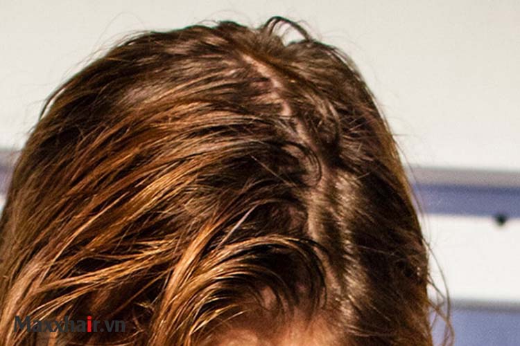 Da đầu như thế nào là dầu? 1 Da đầu như thế nào là dầu? 1