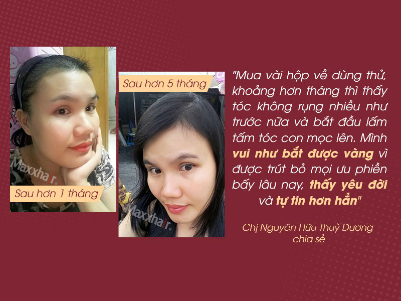Tóc rụng nhiều sau sinh đến trơ da đầu và hành trình tìm lại “mái tóc thanh xuân” 5 Tóc rụng nhiều sau sinh đến trơ da đầu và hành trình tìm lại “mái tóc thanh xuân” 5