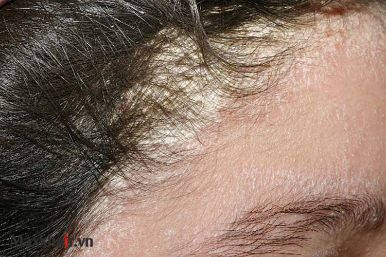 2. Rụng tóc nhiều sau khi ngủ dậy là biểu hiện của bệnh gì? 1 2. Rụng tóc nhiều sau khi ngủ dậy là biểu hiện của bệnh gì? 1