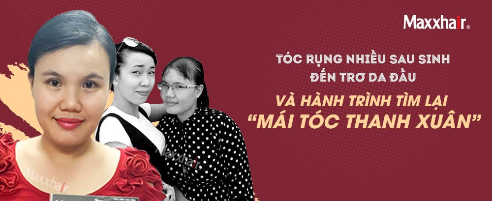 Tóc rụng nhiều sau sinh đến trơ da đầu và hành trình tìm lại “mái tóc thanh xuân” 1 Tóc rụng nhiều sau sinh đến trơ da đầu và hành trình tìm lại “mái tóc thanh xuân” 1