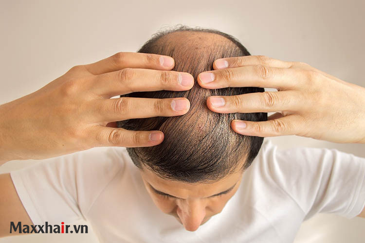 Bệnh hói đầu là gì? 1 Bệnh hói đầu là gì? 1