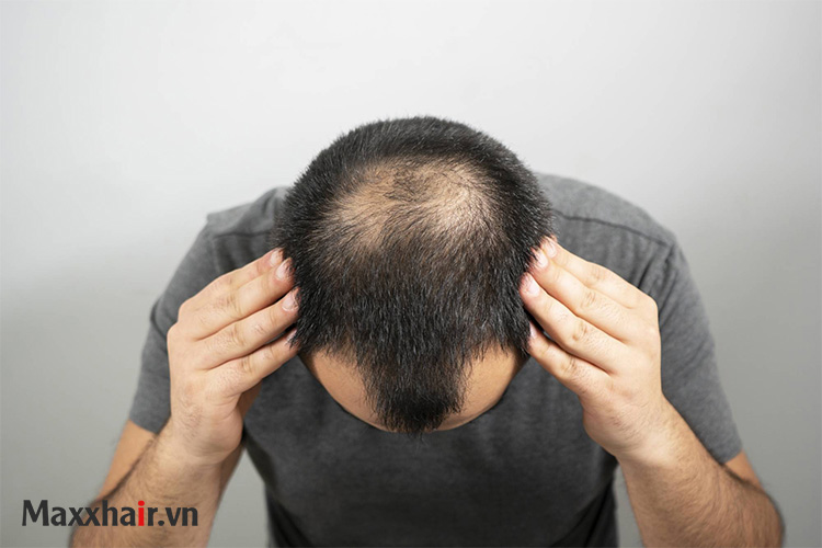 Dấu hiệu hói ở nam giới 1 Dấu hiệu hói ở nam giới 1