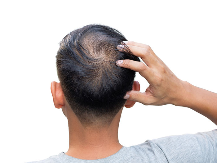 Trẻ tuổi mà đi đâu cũng bị gọi là chú vì hói đầu, phải làm sao đây? 1 Trẻ tuổi mà đi đâu cũng bị gọi là chú vì hói đầu, phải làm sao đây? 1