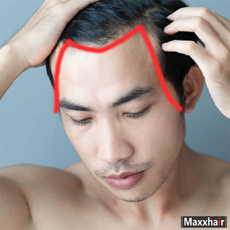 Bị rụng tóc ở 2 bên thái dương là biểu hiện của hói chữ M Bị rụng tóc ở 2 bên thái dương là biểu hiện của hói chữ M