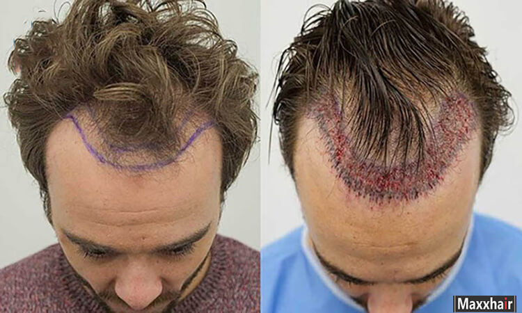 Cấy tóc tự thân là phương pháp tốt nhất giúp trị hói chữ M Cấy tóc tự thân là phương pháp tốt nhất giúp trị hói chữ M