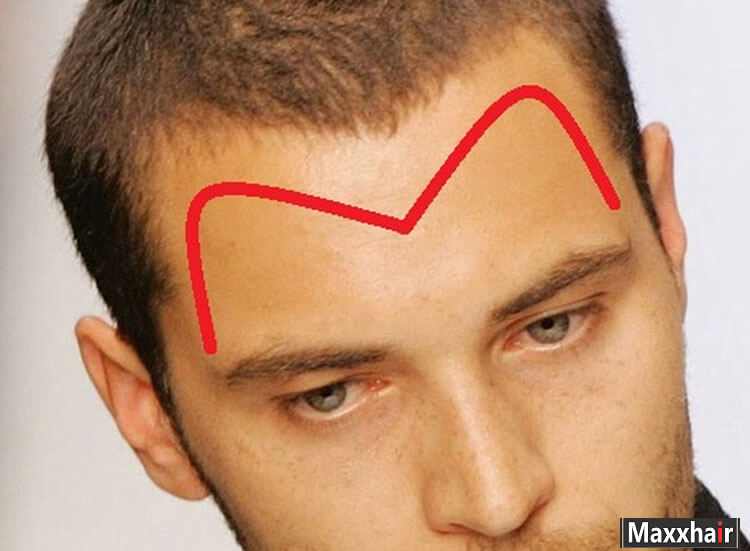 Hói chữ M có thể chữa trị được không tuỳ vào nguyên nhân khác nhau Hói chữ M có thể chữa trị được không tuỳ vào nguyên nhân khác nhau