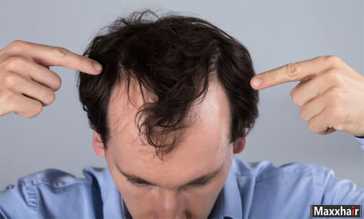 Nam giới là đối tượng dễ bị hói chữ M Nam giới là đối tượng dễ bị hói chữ M