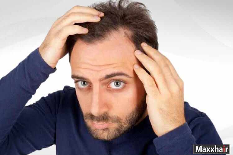 Hói chữ M do các nguyên nhân như di truyền, bệnh lý, căng thẳng Hói chữ M do các nguyên nhân như di truyền, bệnh lý, căng thẳng